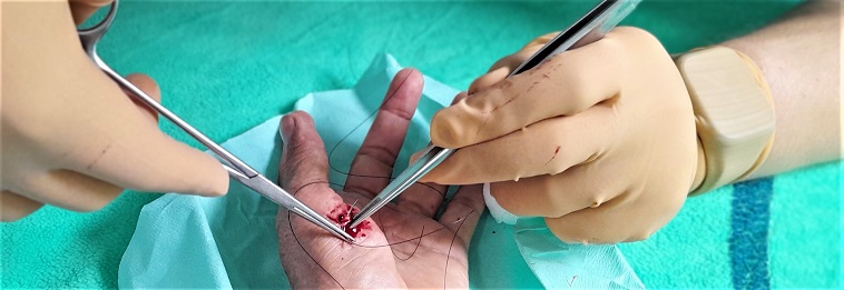 Trois points de suture dans le gras du pouce gauche, mar. 2024